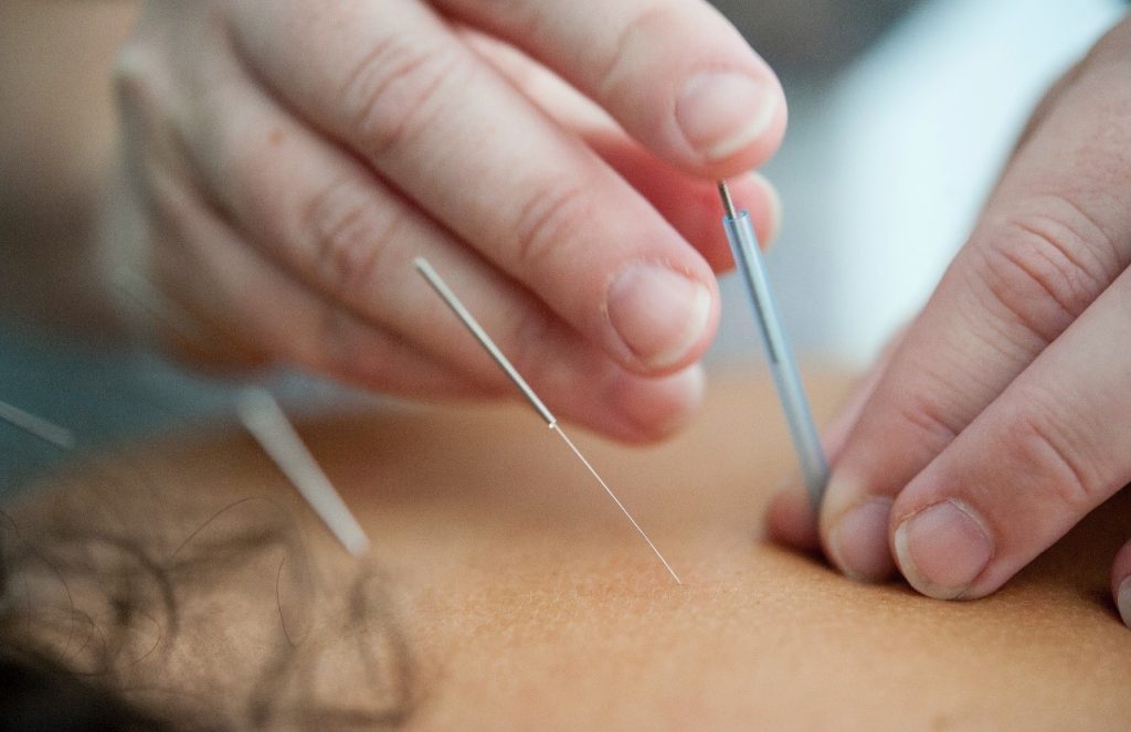 What is Acupuncture and Chinese Medicine?